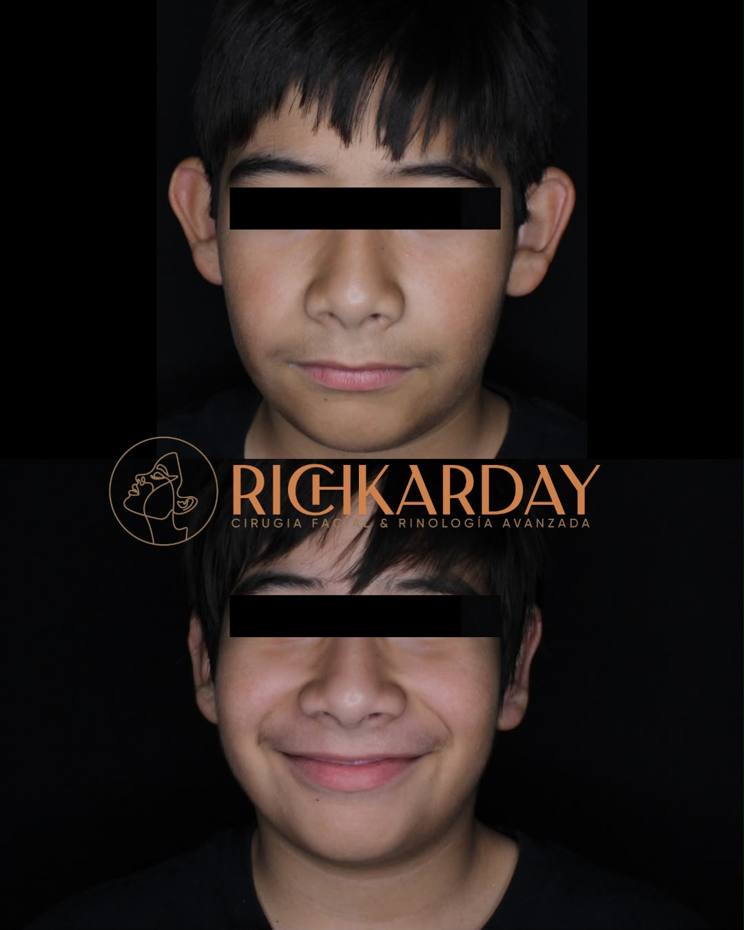 Cirugía realizada por la Dra. Estefanía Richkarday - antes y después caso 1
