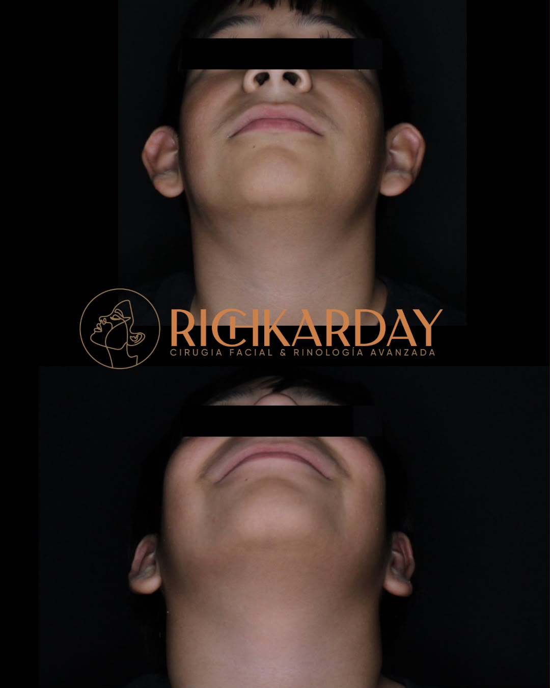 Cirugía realizada por la Dra. Estefanía Richkarday - antes y después caso 2