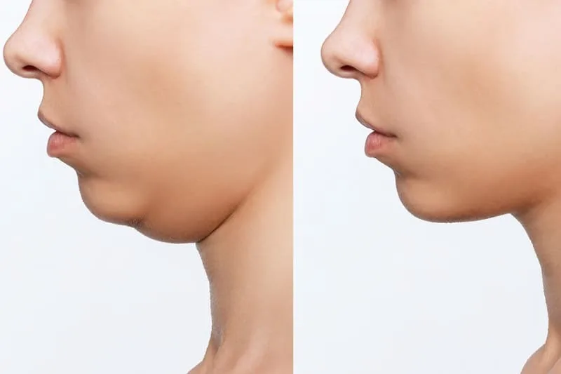 ¿Qué es una cirugía facial estética en Mexicali, Baja California?